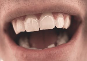 lente de contato dos dentes