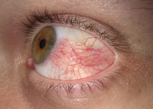 olhos vermelhos