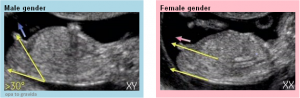 tubérculo fetal