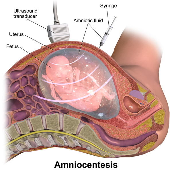 Amniocentese - O que é, Quando Fazer e Como é Feita | Famivita Amniocentese - O que é, Quando Fazer e Como é Feita | Famivita