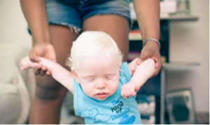 bebe albino